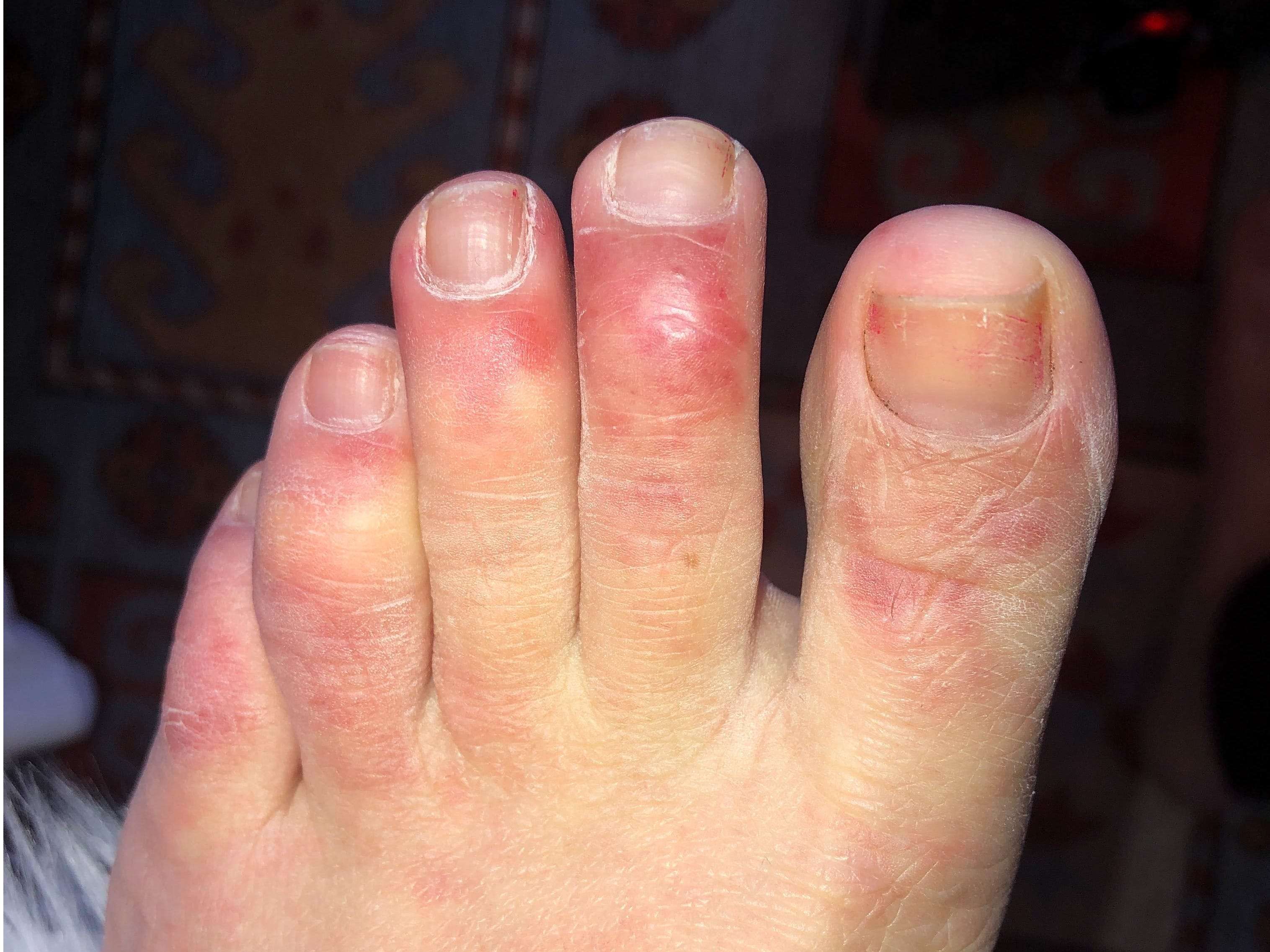 covid-toes-blisters-and-splotchy-red-skin-doctors-share-the-new