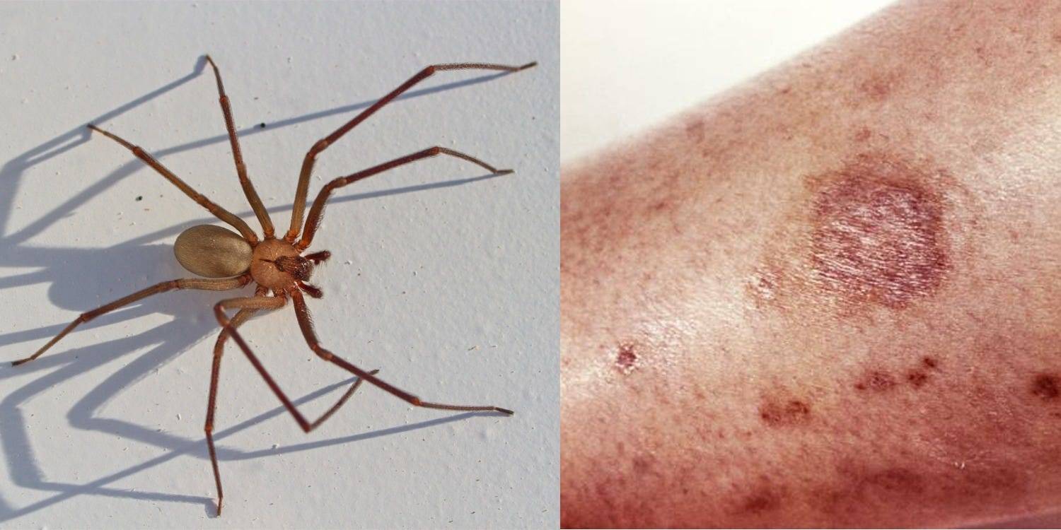 What Does Initial Brown Recluse Spider Bite Look Like : Spider Bites ...