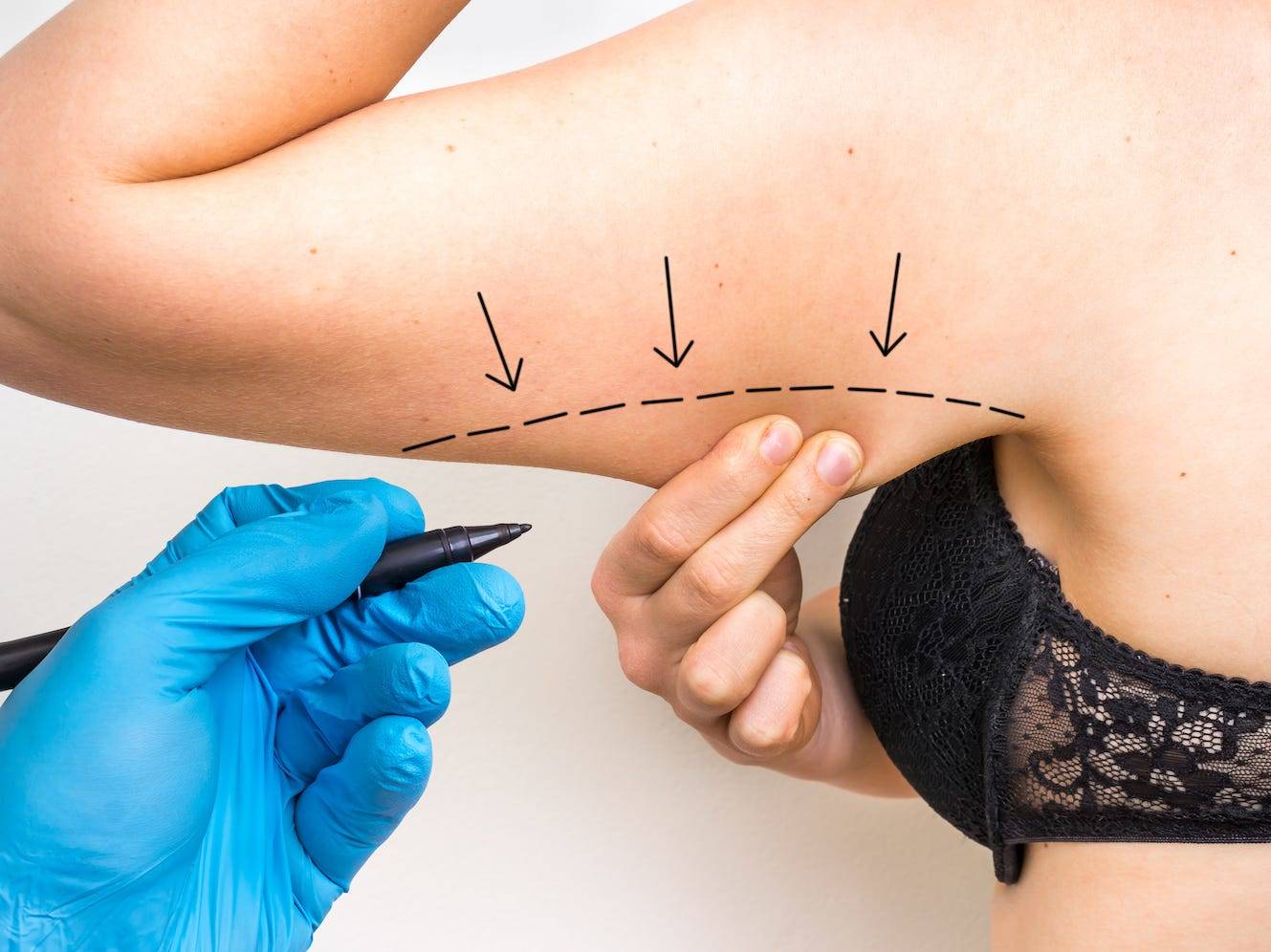 what-is-liposuction-how-the-procedure-works-and-how-painful-it-is