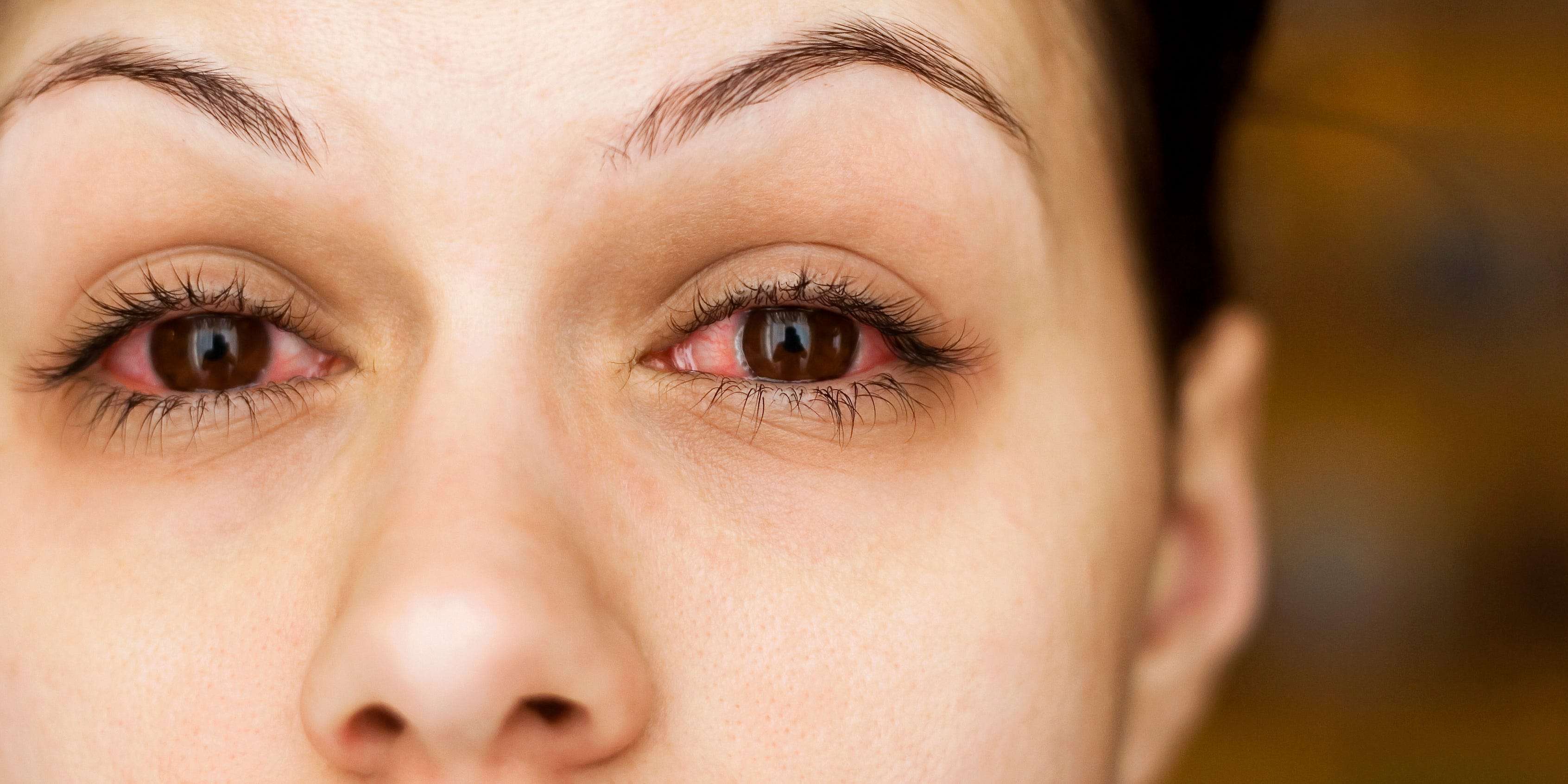 do-you-have-viral-or-bacterial-pink-eye-how-to-tell-the-difference-and