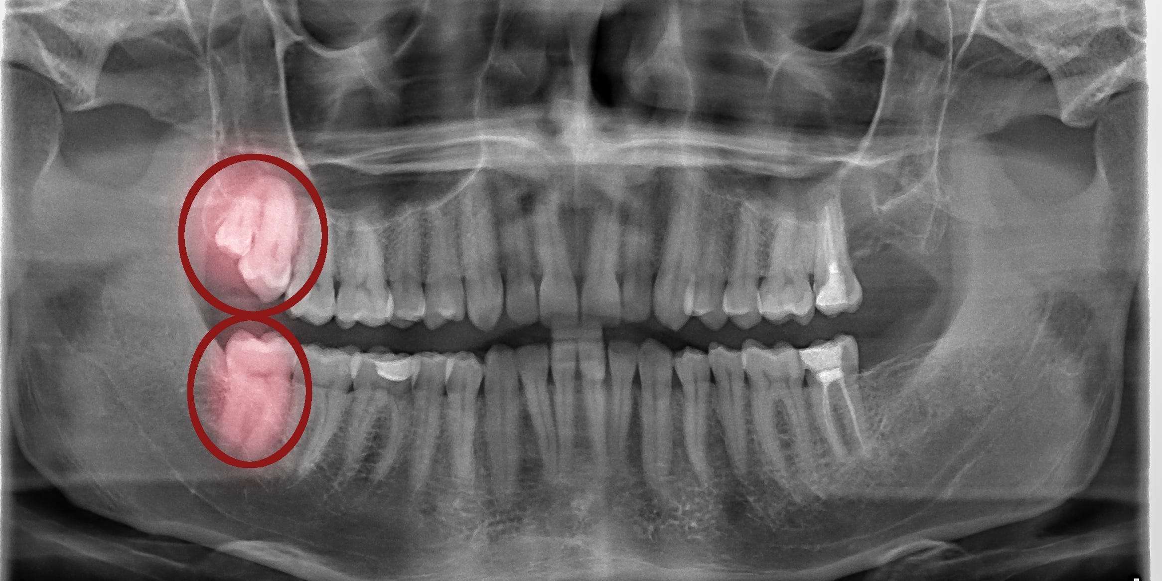 Why Impacted Wisdom Teeth Are So Dangerous Business Insider India