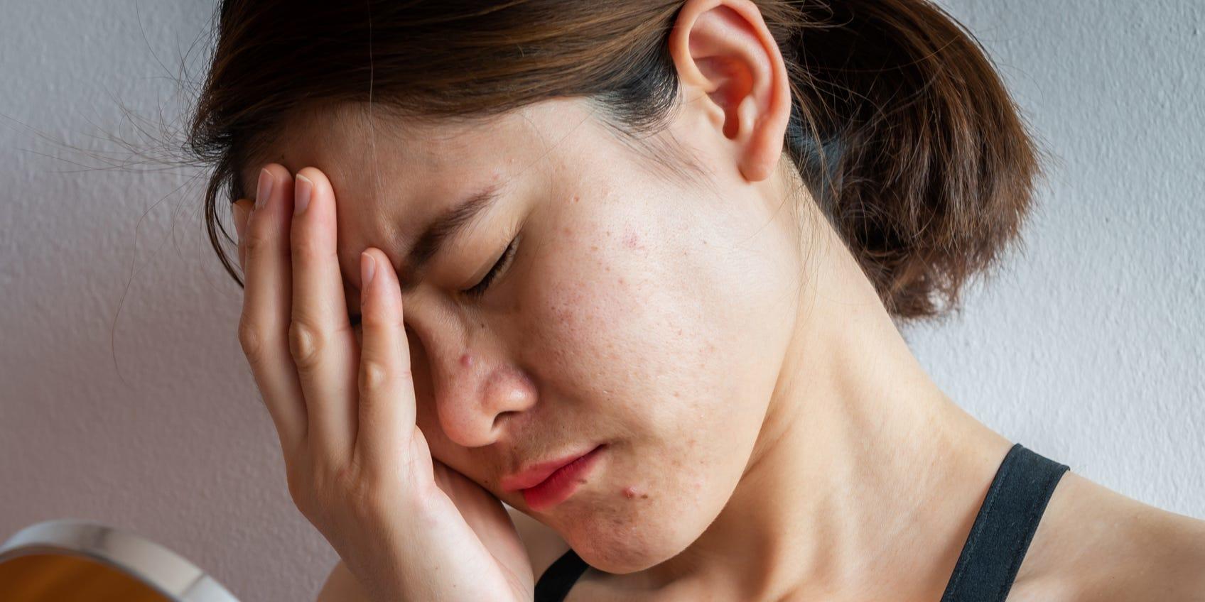 why-stress-causes-you-to-breakout-and-how-to-get-rid-of-stress-acne