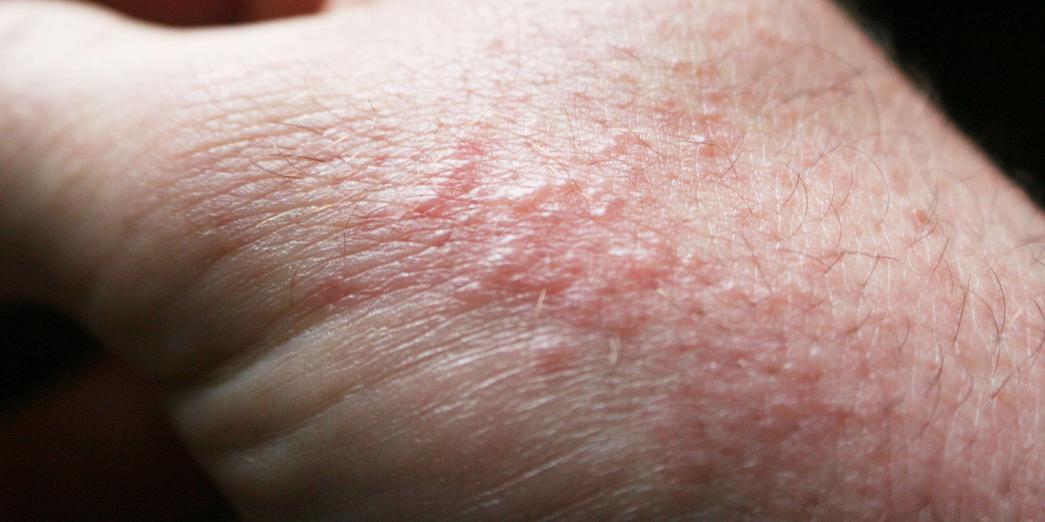 How to tell if you have a poison oak rash and how to treat it