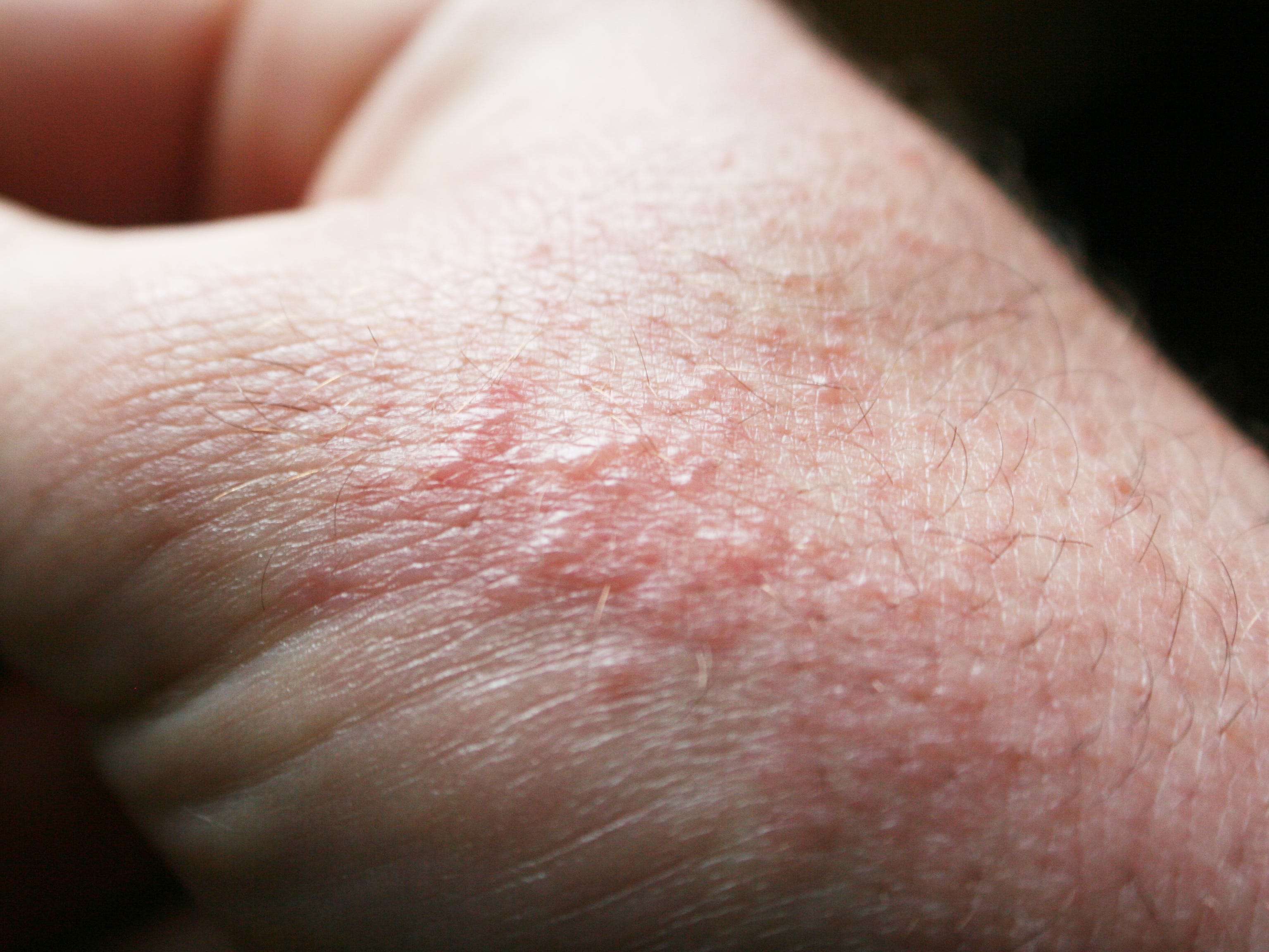 How to spot poison oak and the rash it causes | Business Insider India