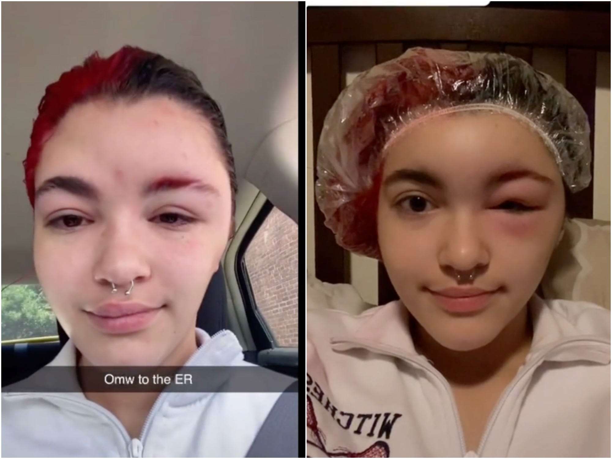 This Womans Face Ballooned And She Had To Shave Her Head After An Allergic  Reaction To Hair Dye  Media Drum World