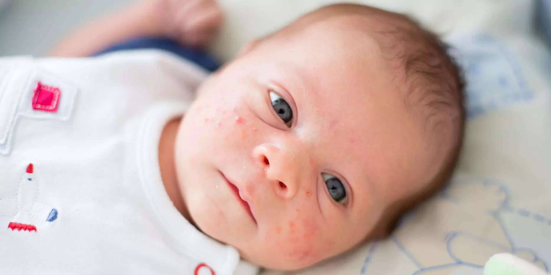 is-baby-acne-a-real-thing-know-all-about-it