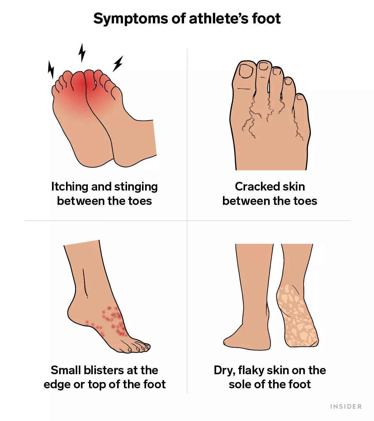 How to tell when you have athlete's foot and what to do about it ...