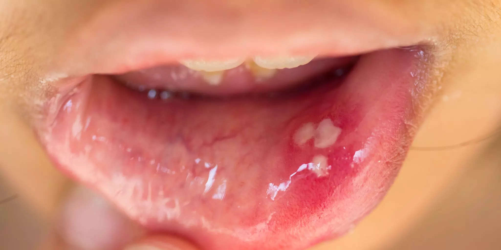 White spots on gums can develop because of a fungus overgrowth, called oral thrush.You may also notice white spots that burn when you eat if you have canker