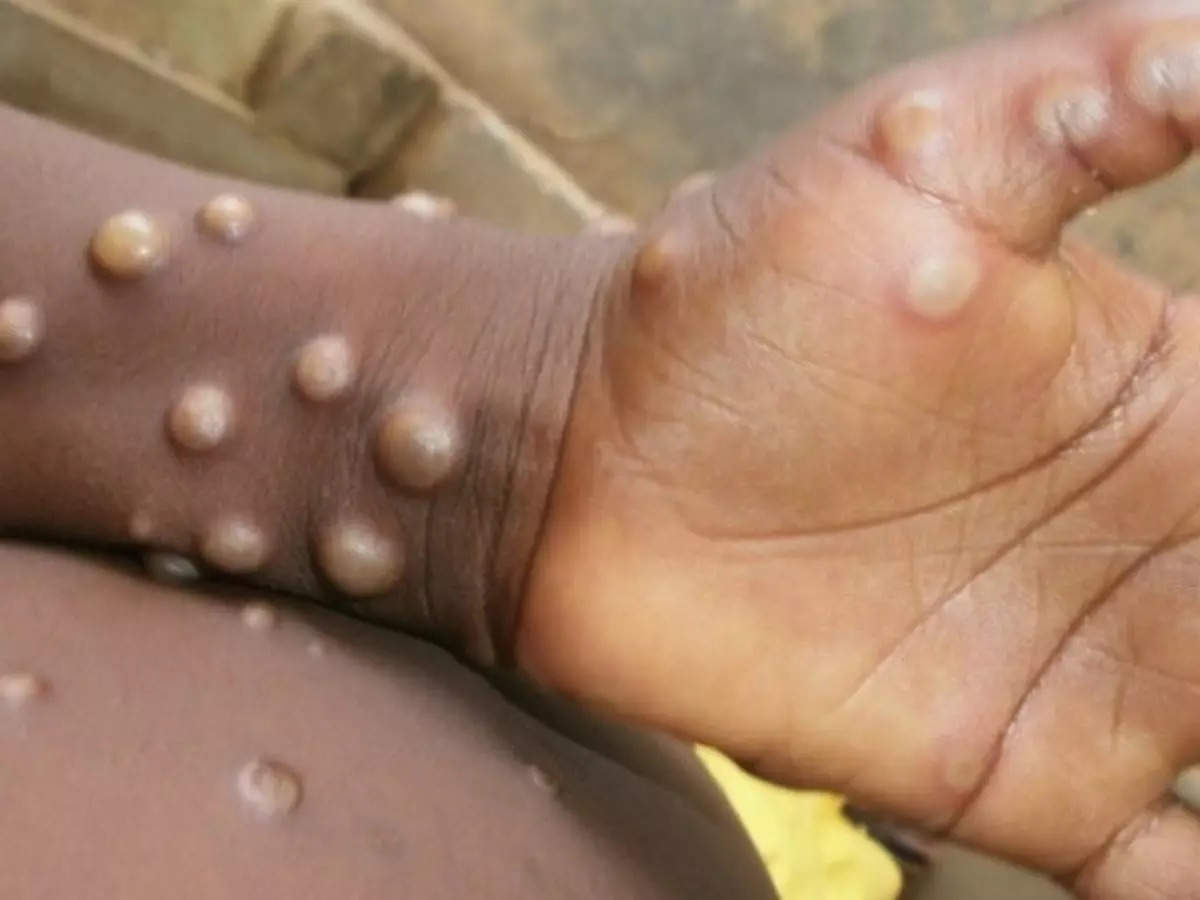 African countries reported 6,883 monkeypox cases and 173 deaths in 2022