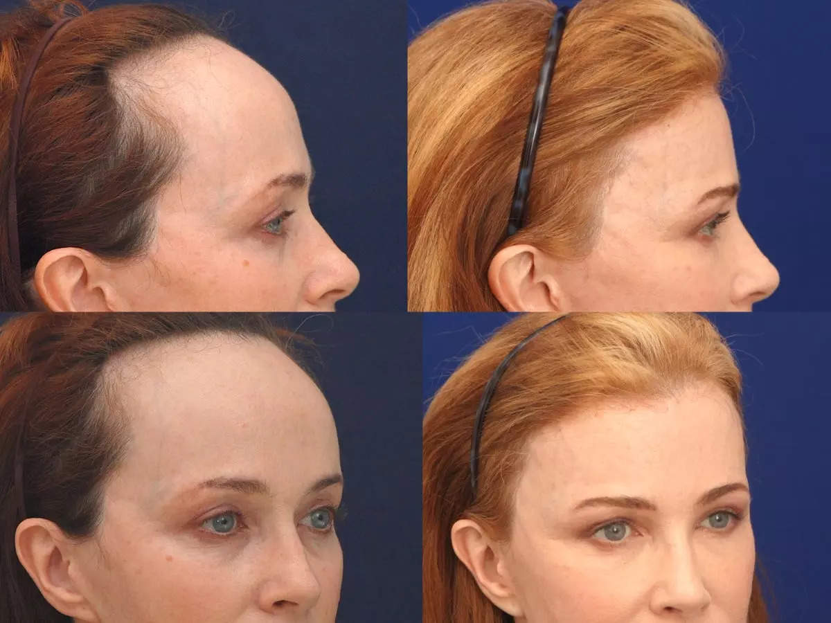 A Plastic Surgeon Who Performs Forehead Reduction Surgeries To Lower Hairlines Shares Before And After Photos And What To Expect ?imgsize=65922