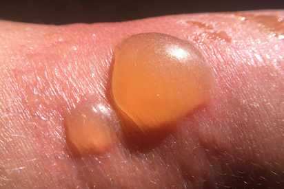How to get rid of sunburn blisters with aloe, a cool compress, and