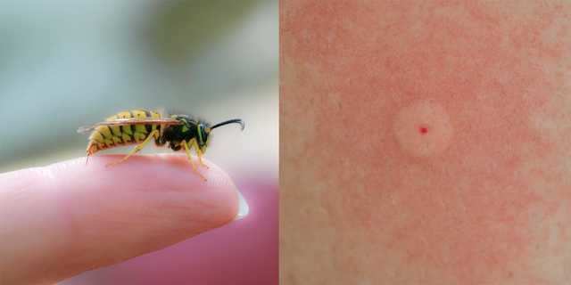 How to identify common bug bites, and treat them properly ...