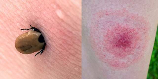 How to identify common bug bites, and treat them properly ...